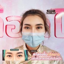 ตา 2 ชั้น